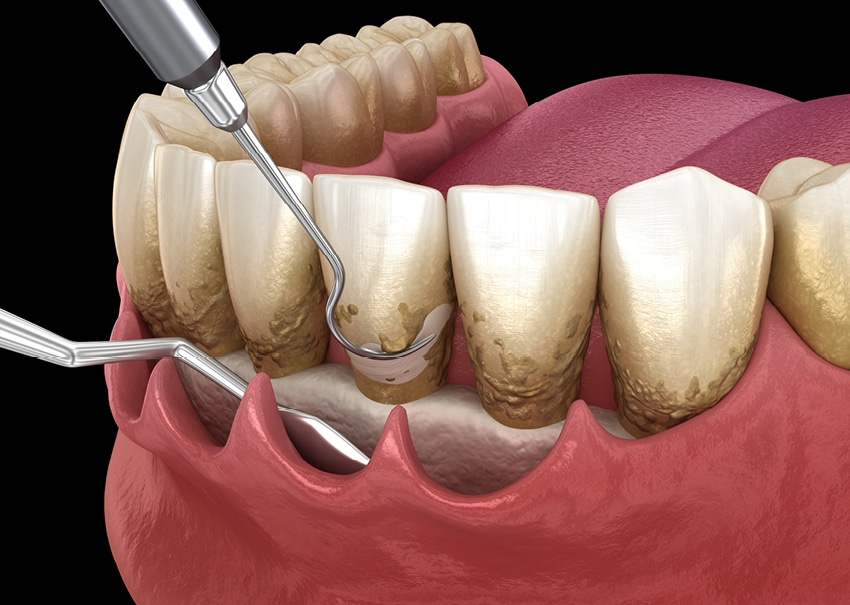 parodontitida