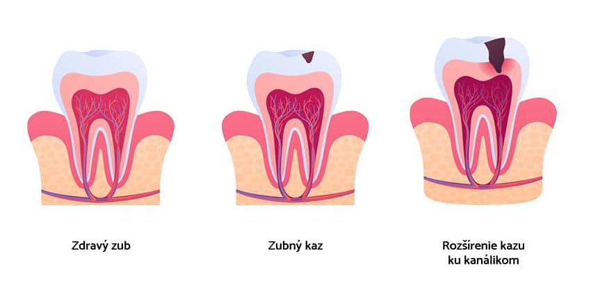 endodoncia postup